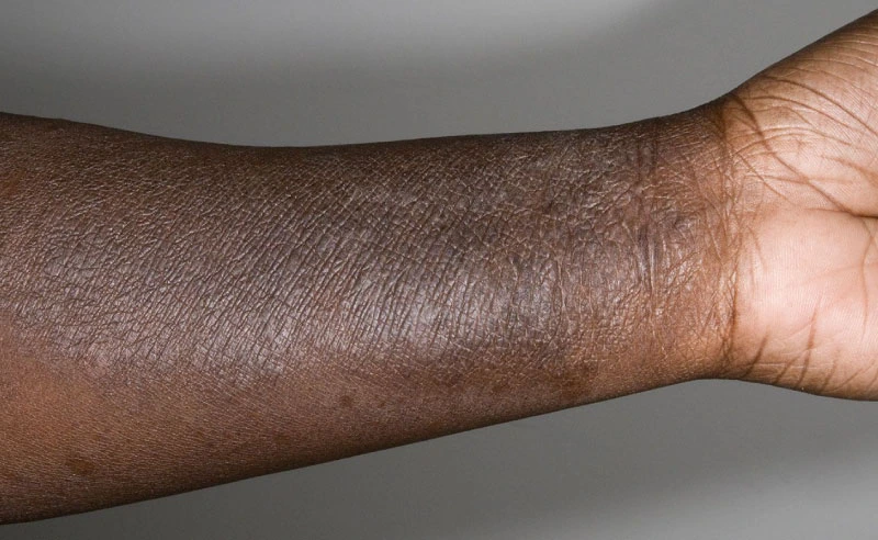 A close-up of atopic eczema on black skin, showing dry, inflamed patches and visible irritation.