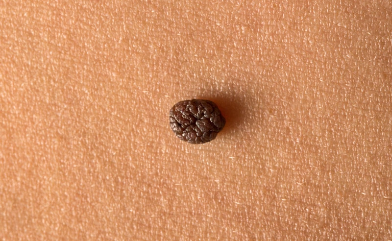 A close-up of a suspicious wart on the skin, highlighting a potential skin growth or lesion.