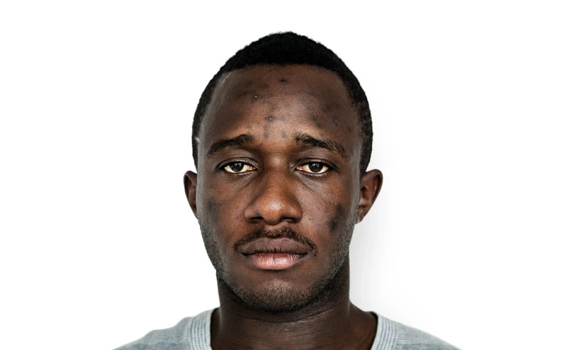 A male model with visible facial acne, highlighting common skin concerns and natural complexion.