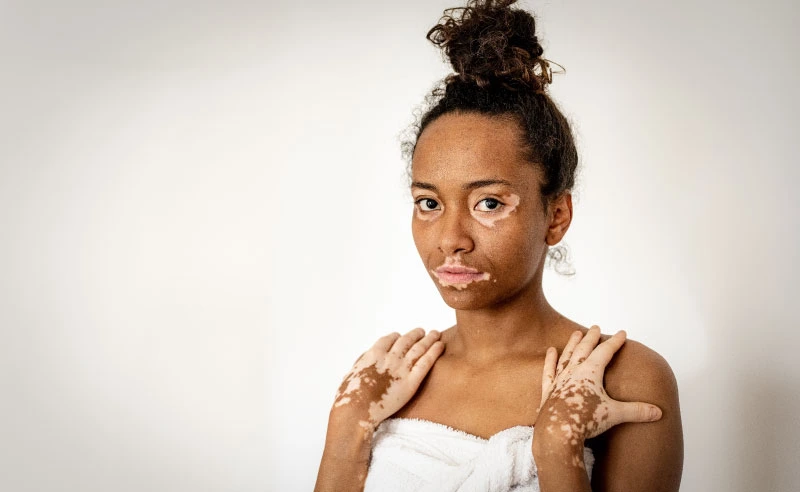 A young African-woman with vitiligo smiling and holding a towel, representing body positivity and skincare awareness against a white background.