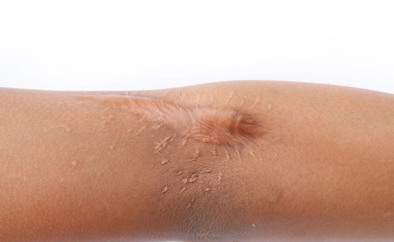 Close-up of a hand with visible scars against a plain white background, highlighting skin texture and healing marks.