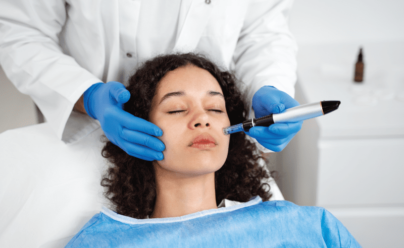 Close-up of a patient undergoing a microneedling treatment performed by a professional aesthetician using a specialized derma pen on the cheek area.